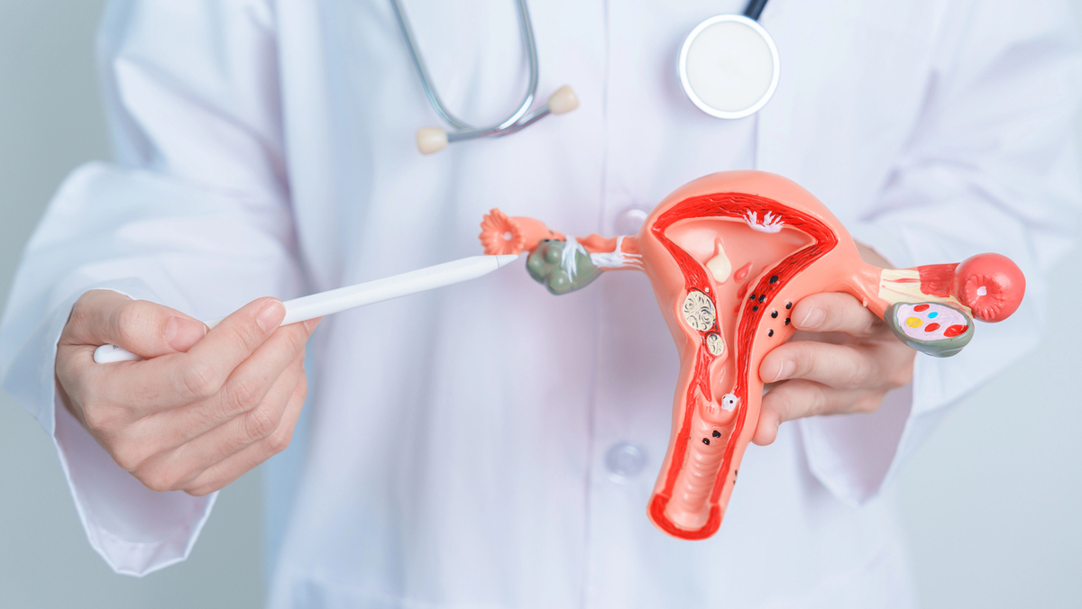 médico aponta ovário em maquete