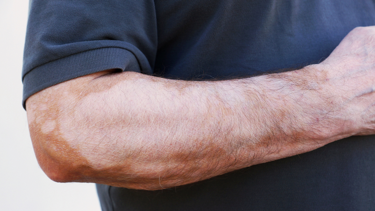 Piebaldismo o que é e como cuidar da pele? Drauzio Varella Drauzio