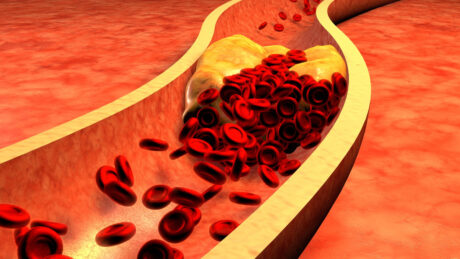 desenho de placa de colesterol impedindo a passagem do sangue em artéria