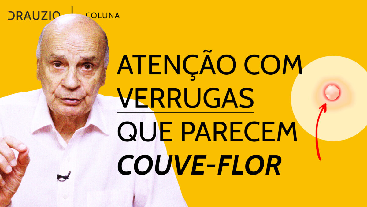 Saiba diferenciar as verrugas do HPV de outros tipos de verruga