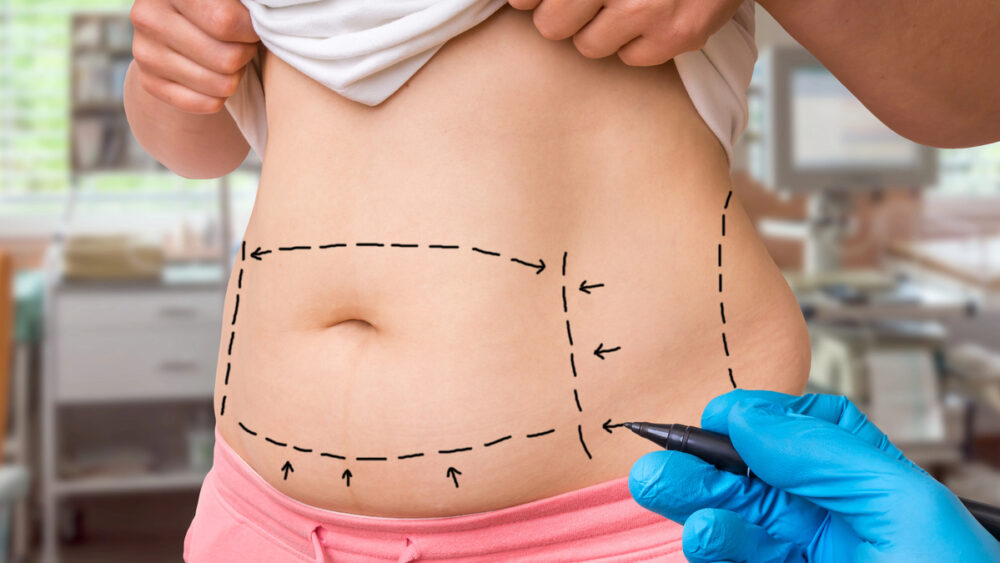 Mais definição ou menos gordura? Entenda o que muda entre os tipos de lipoaspiração e veja como escolher