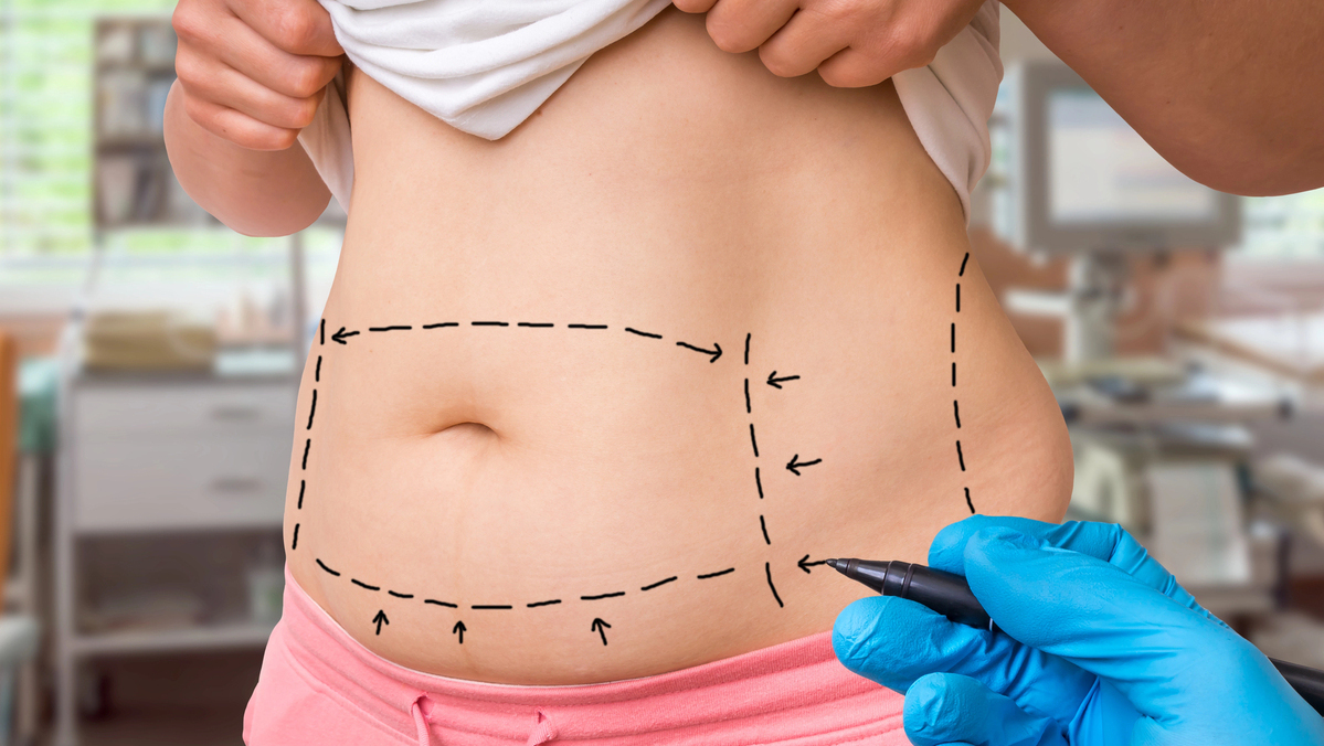 Mais definição ou menos gordura? Entenda o que muda entre os tipos de lipoaspiração e veja como escolher