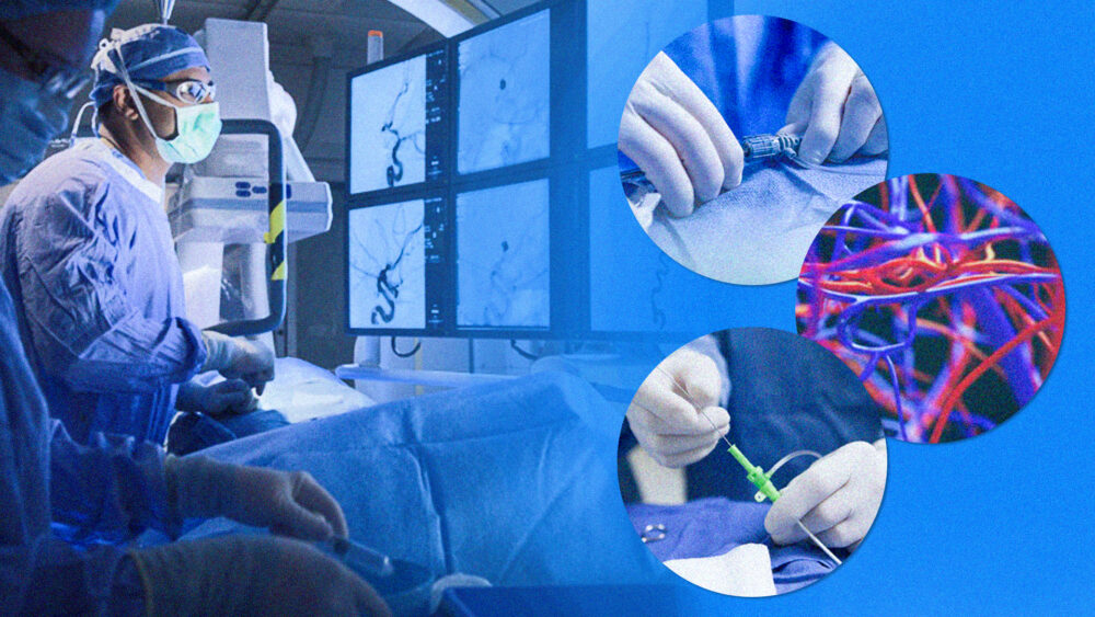 Já imaginou fazer uma cirurgia para tratar um câncer e sair do hospital no mesmo dia? Conheça as cirurgias minimamente invasivas da radiologia intervencionista e para que elas servem
