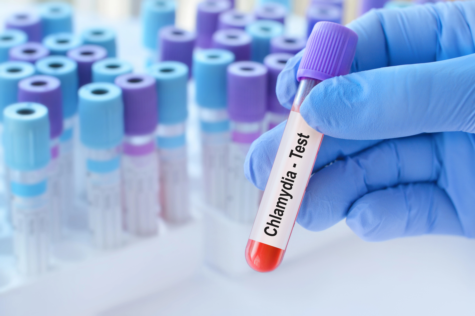 Clamídia é a IST bacteriana mais comum no mundo e pode causar complicações graves