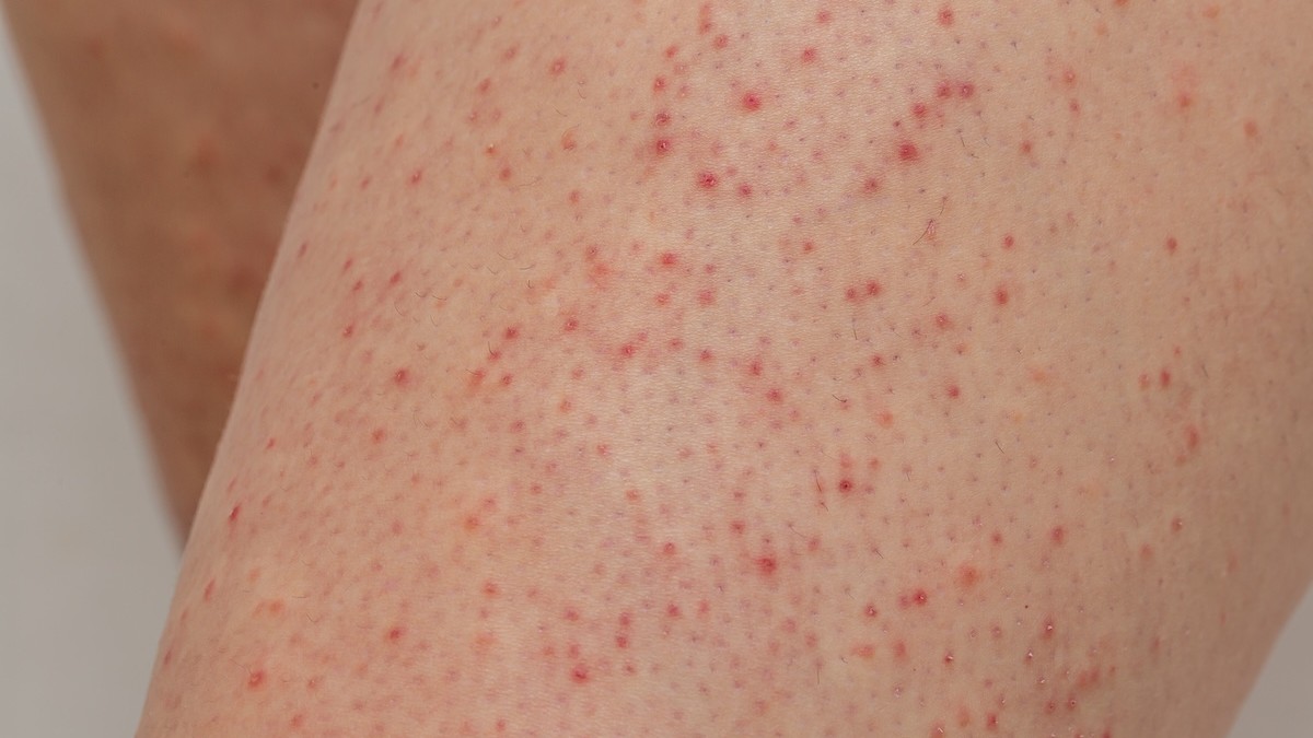 Queratose pilar